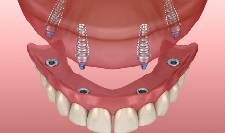 Особенности протезирования зубов.